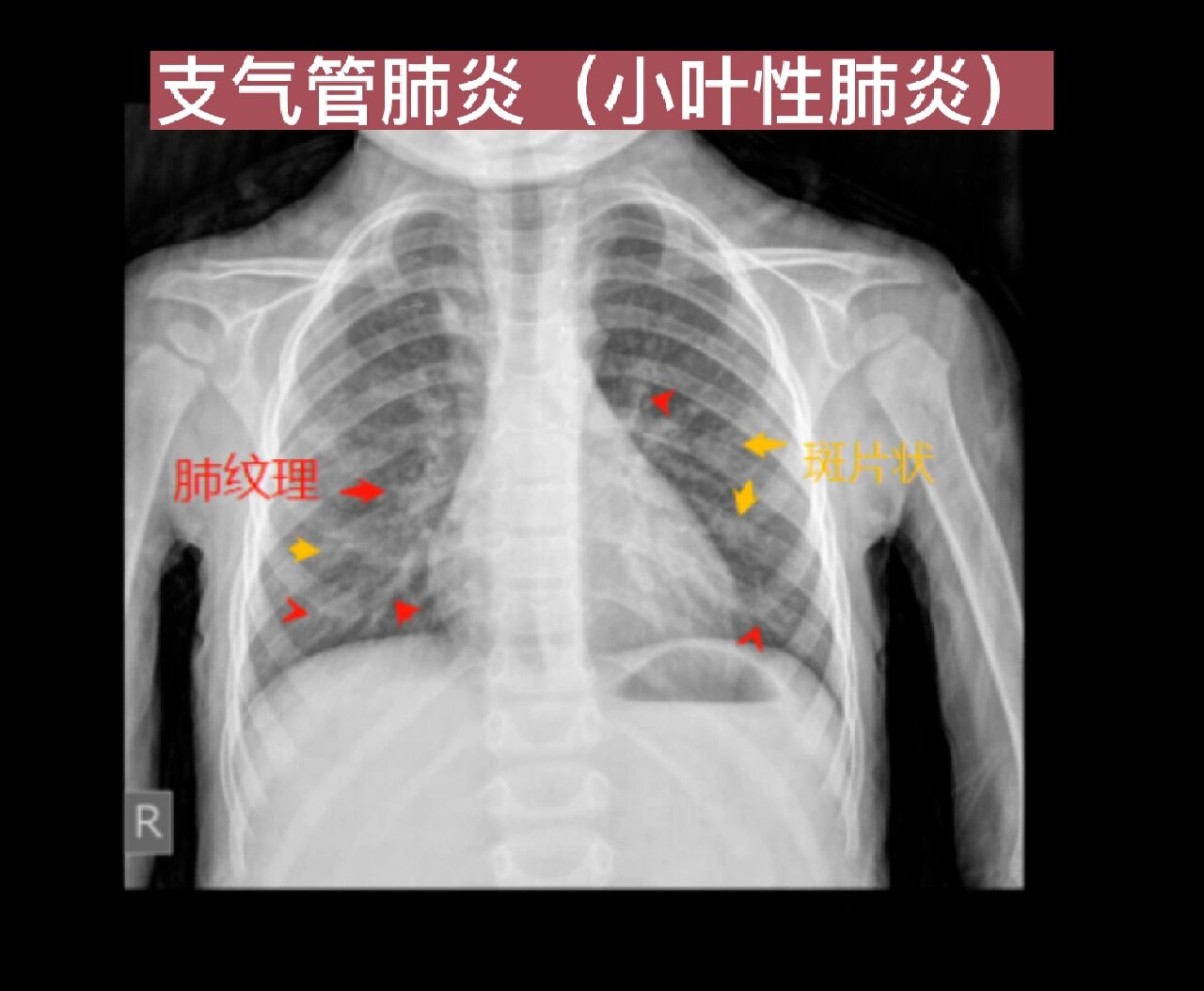 肺部x光片怎么看图片