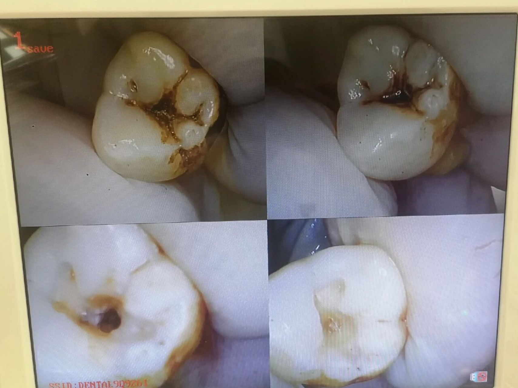 练习补牙日常(深龋近髓)补牙还是治疗呢?