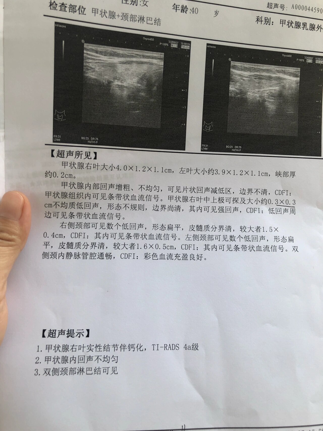 甲状腺结节4a半年复查 今天内分泌科让我转普外科了,又新做了个b超.
