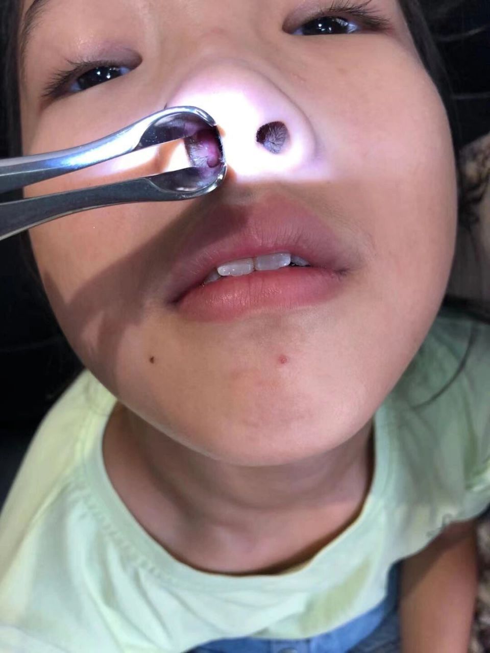 下鼻甲肥大症状表现:鼻塞,交替塞,打呼噜,张口呼吸,因下鼻甲积脓