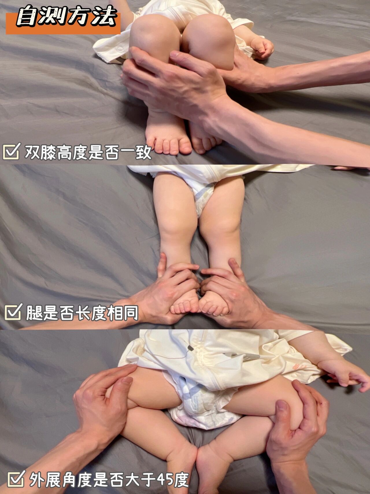 宝宝腿纹不对称很可能是髋关节发育不良