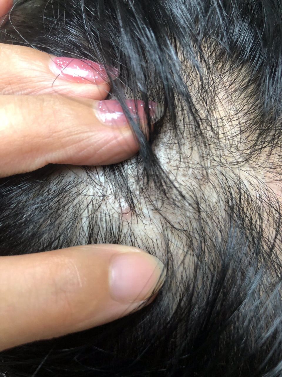 真的有这么严重和顽固吗? 7115这种头皮毛囊炎是什么?