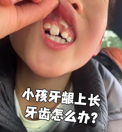 孩子牙龈上长牙齿不用太担心,很多情况下是正常现象