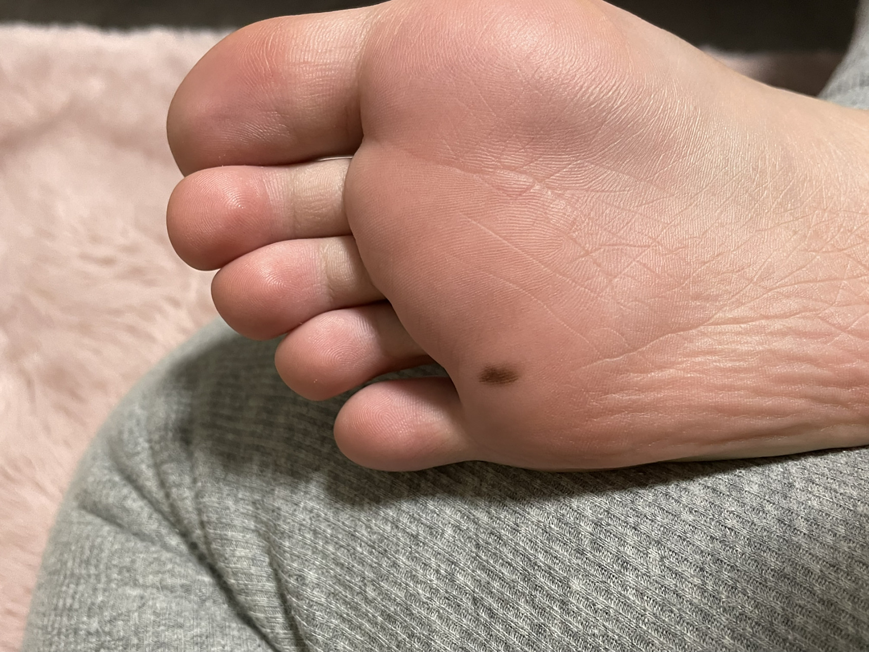 脚底黑色痣 最近小红书怎么总在给我推脚底黑色痣 我也有一个 长了