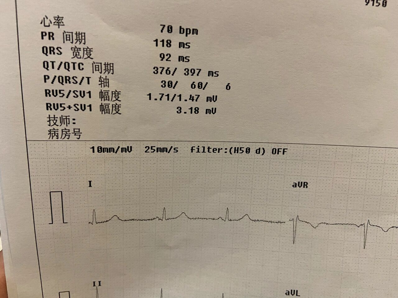 心电图短pr 间期是什么意思