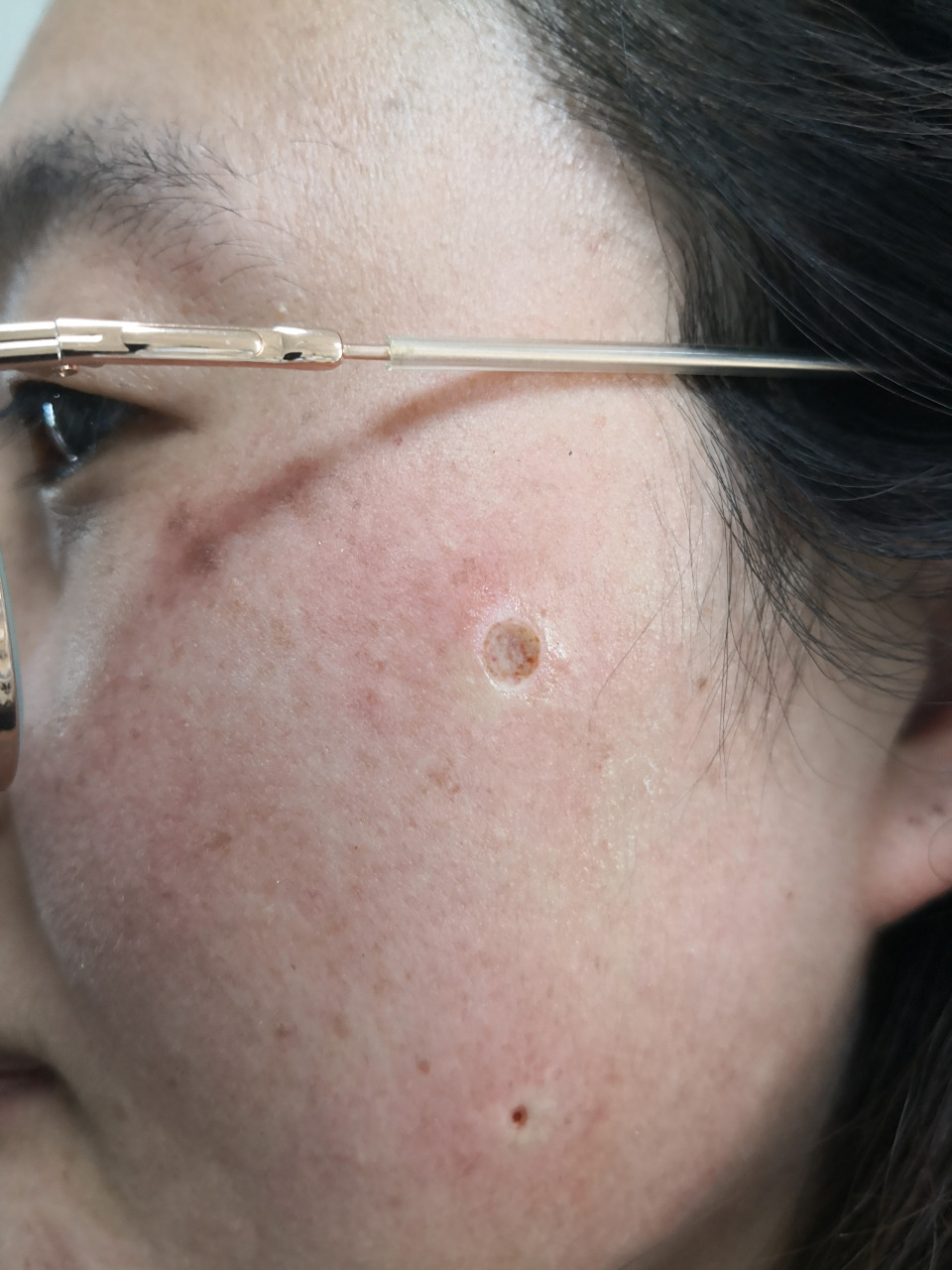 面部色素痣激光治疗去除后即刻图片.