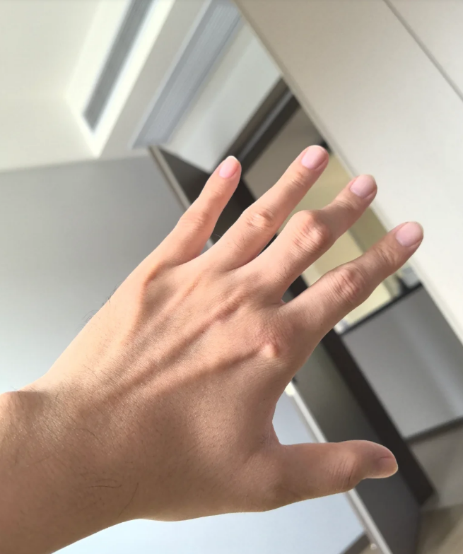 手指关节起个包还痛怎么回事怎么办?