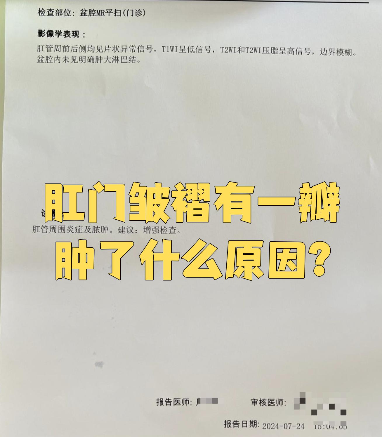 这种外痔的特点是肛门皱襞肥大,皮肤增生,但一般不会疼