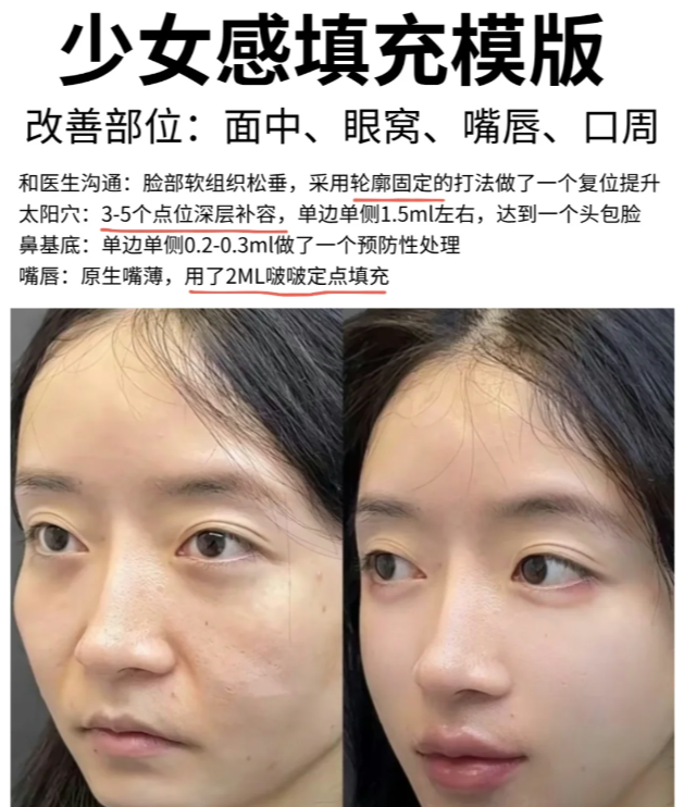 面部有四道不被喜爱的纹,分别是泪沟,印第安纹,法令纹,木偶纹(四大显