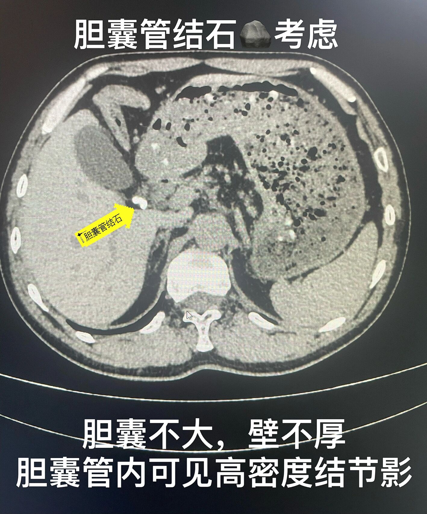 胆系结石(上腹部ct平扫)胆囊 胆系结石的ct表现💕💕💕 	 平扫