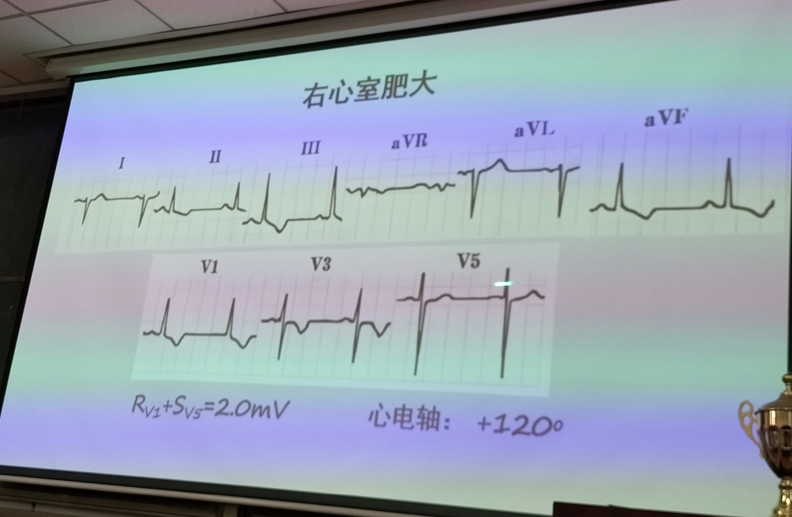 右心室心电图图片