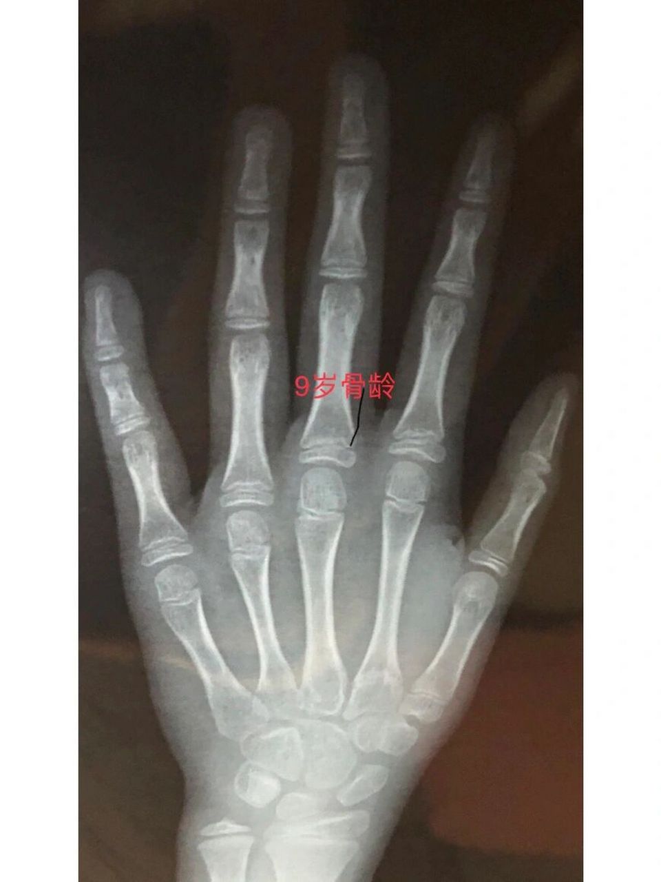 籽骨出现11岁骨龄?
