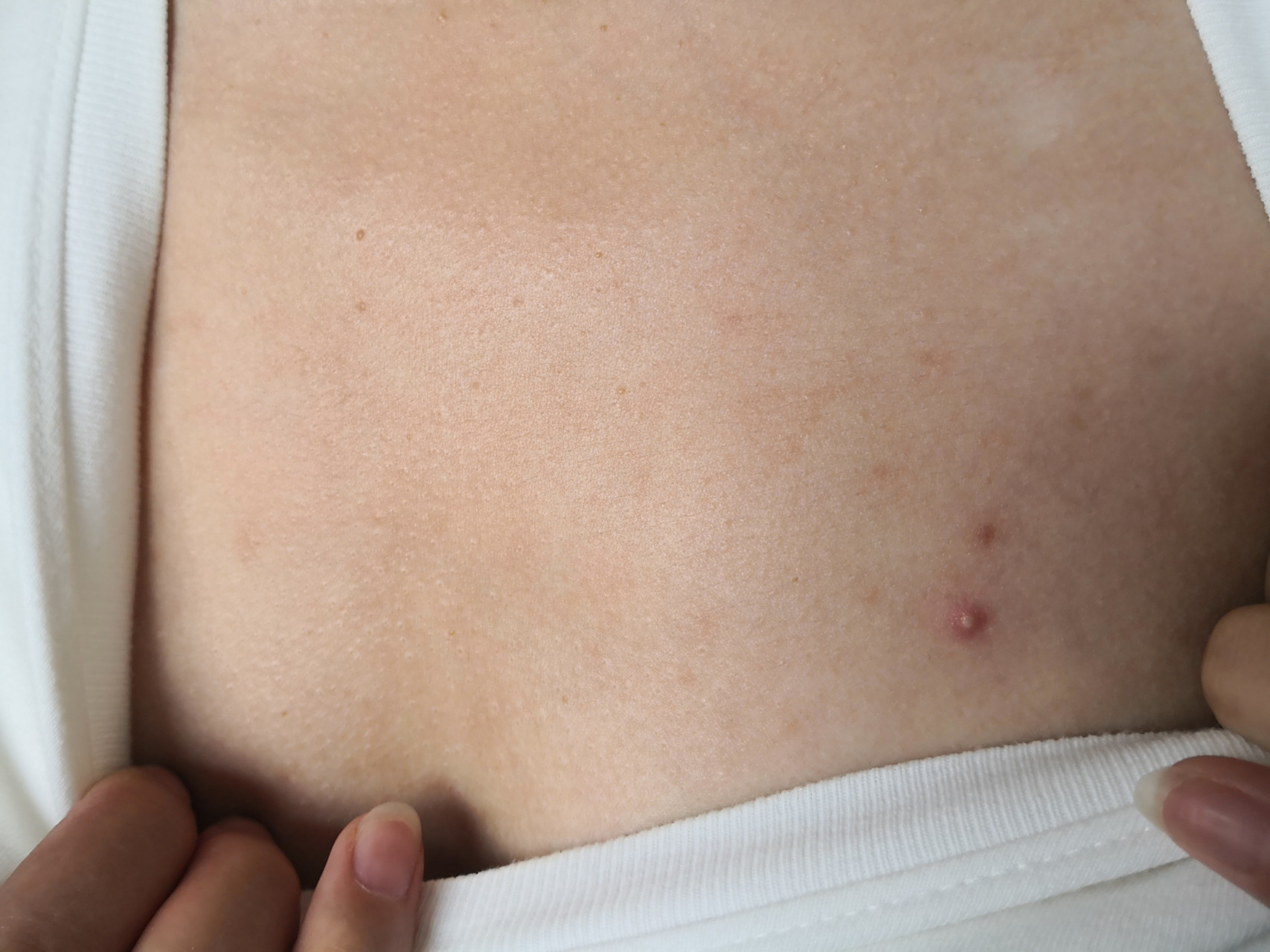 前胸后背毛囊炎症状.药物治疗后效果不错.