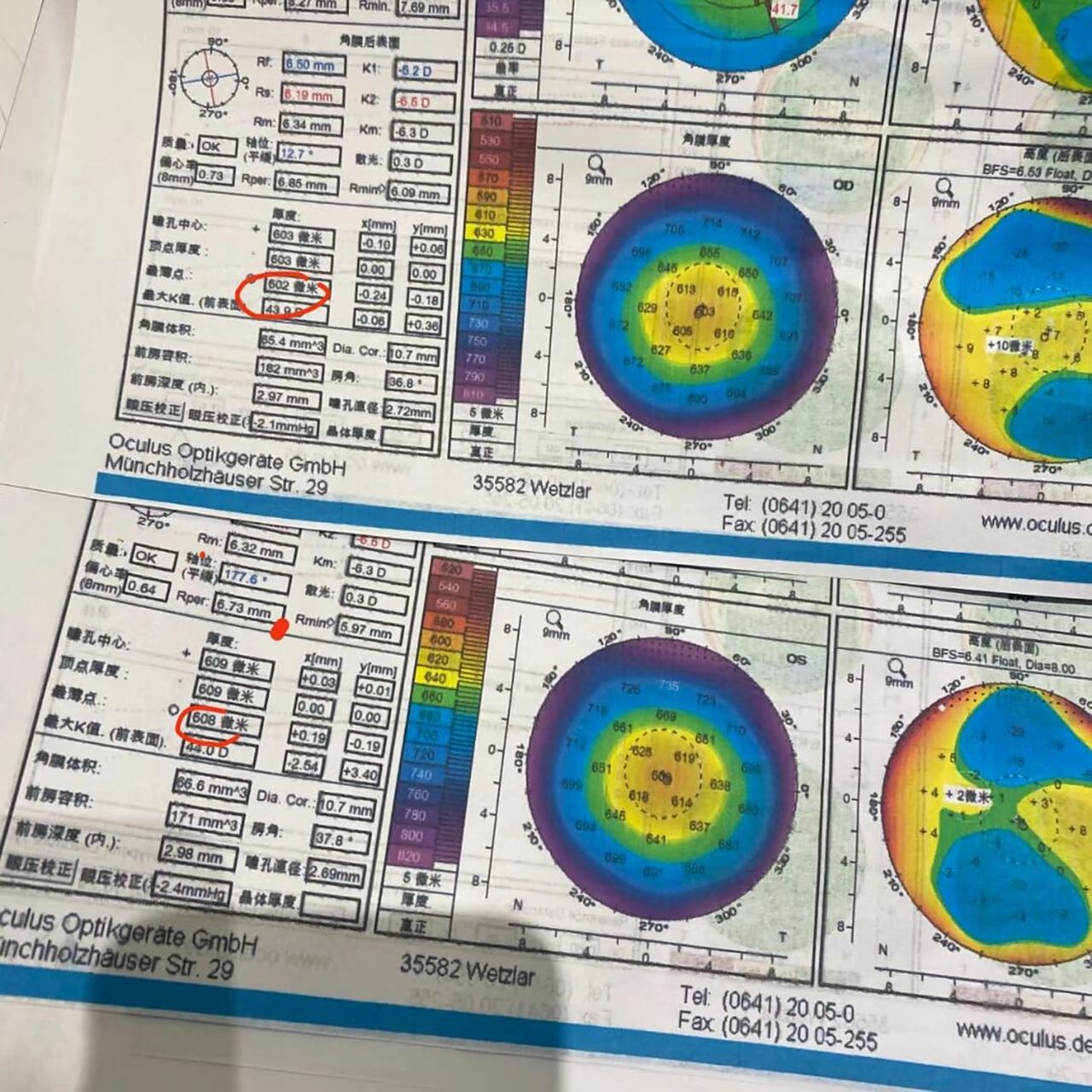 算是很厚的角膜啦 角膜厚度值均在480微米到600微米区间