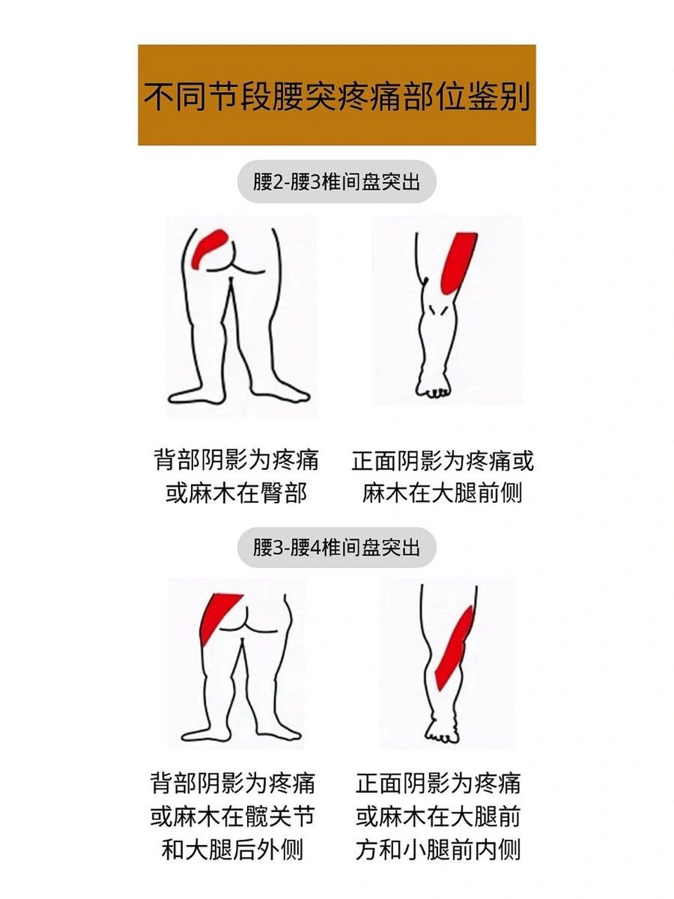 96腰疼星人看过来,不同节段腰疼部位对照 你知道不同节段的腰突