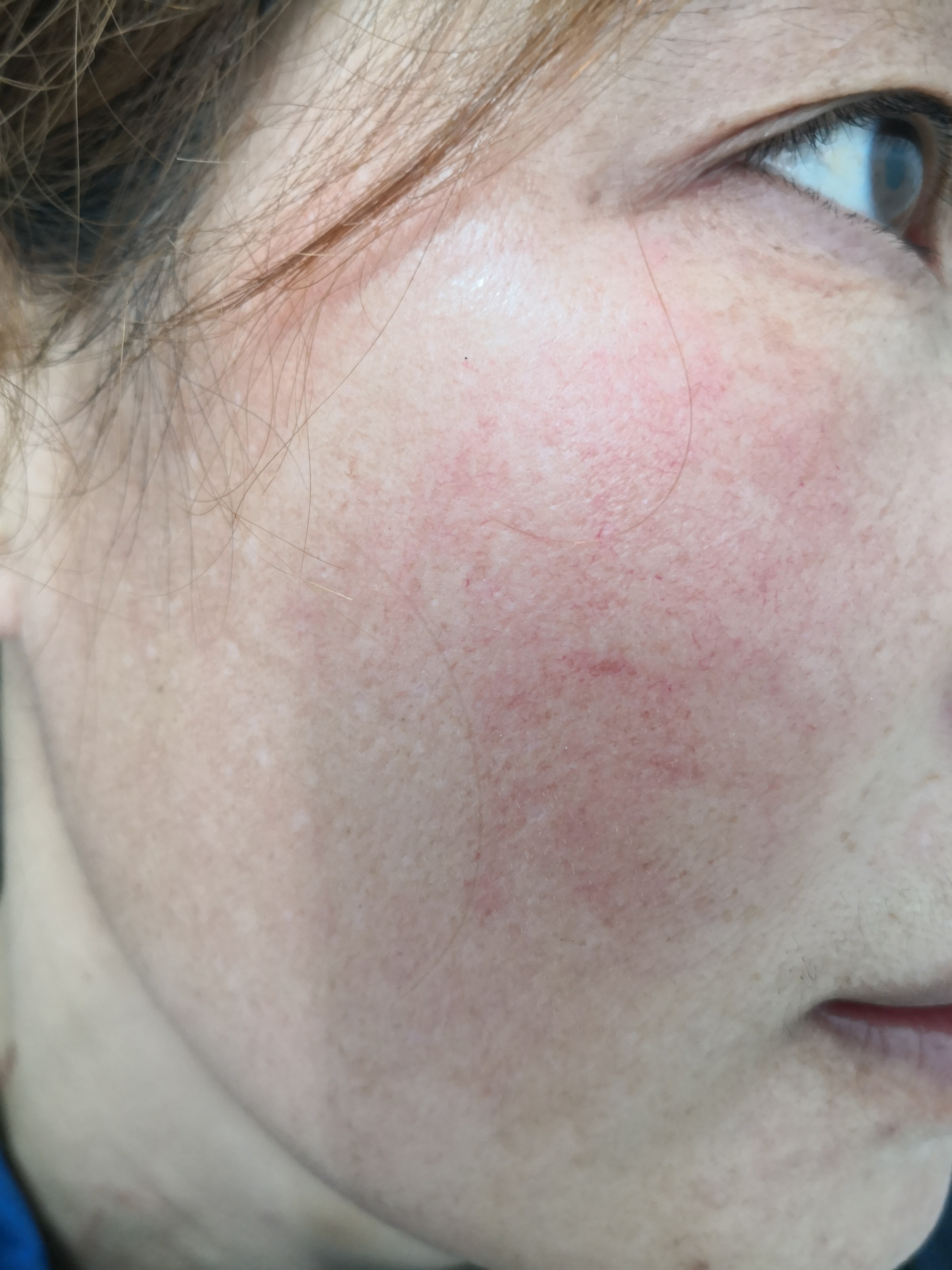 面部潮红红血丝多年并.@纪秀军皮肤科主任医师的动态