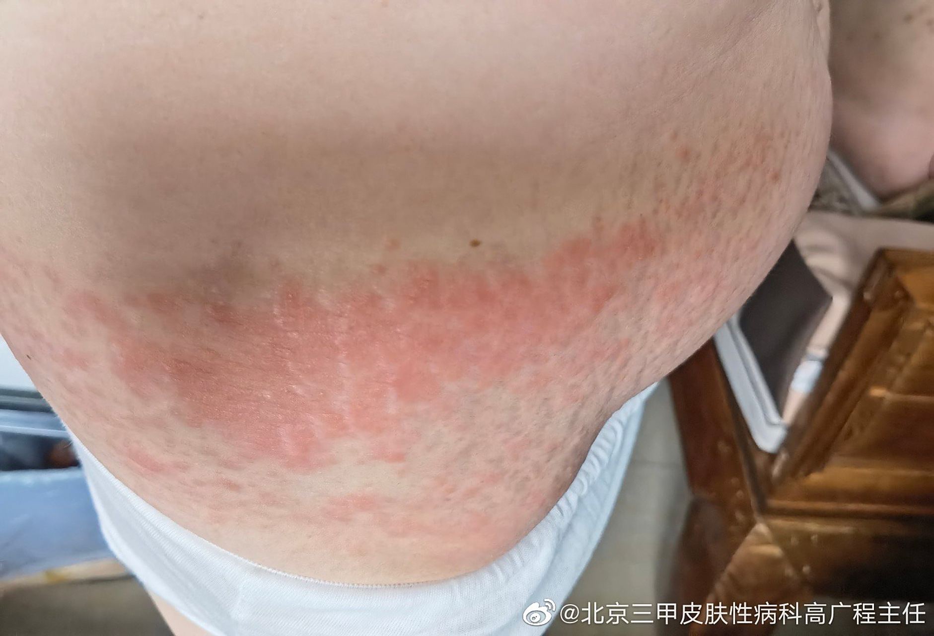 有哪些注意的? 图片表现是过敏反应是湿疹.