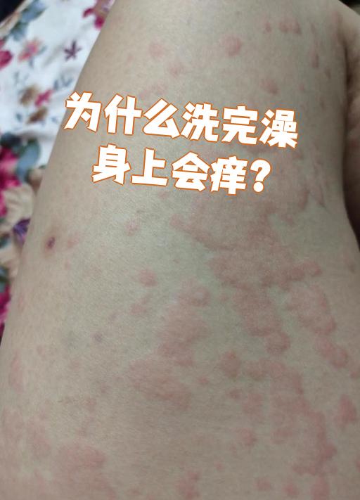 皮肤为什么过敏