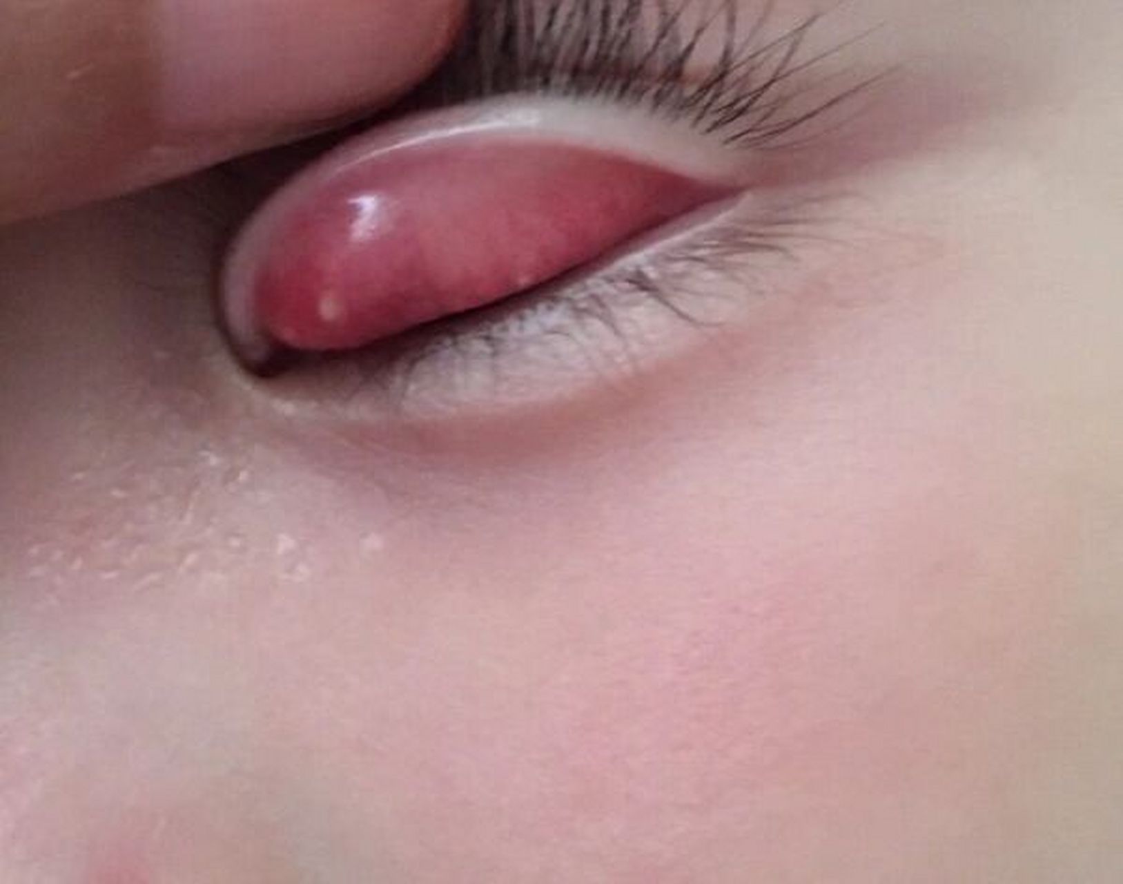 霰粒肿一定要坚持热敷 从图一坚持下来两个月了,终于消的差不多了