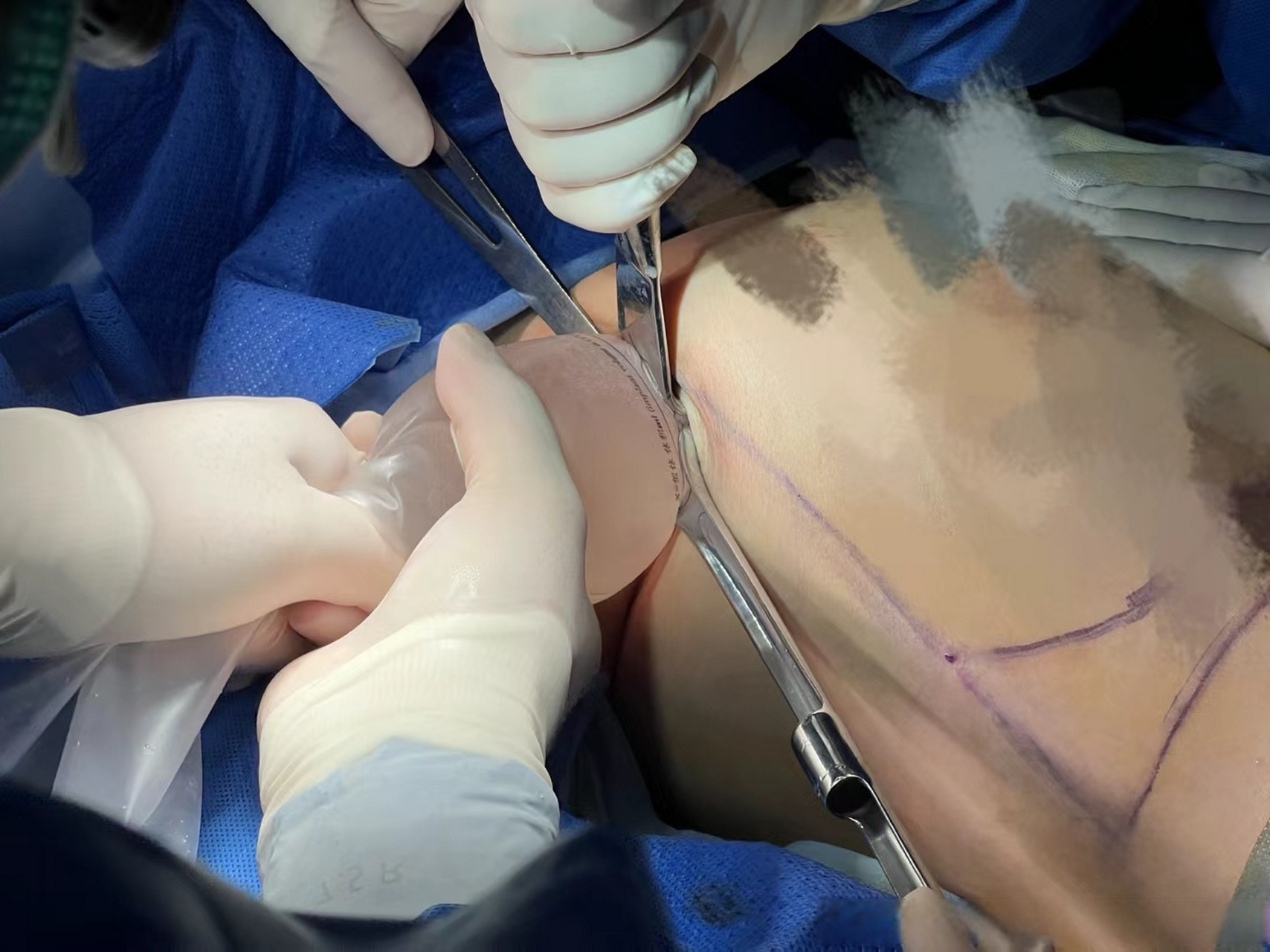 275毫升隆乳假体,十几秒钟就填充到胸大肌后间隙,这个漏斗传送袋是