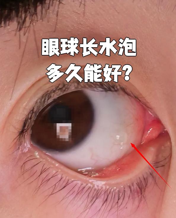 眼球长水泡