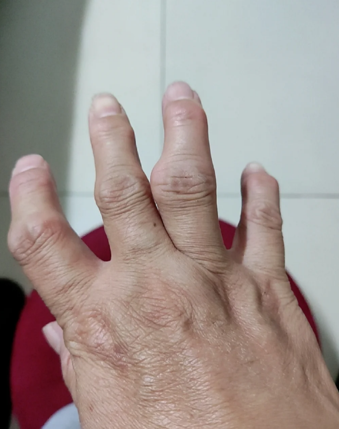 手指骨关节肿大变形的患者不要自己随便吃药,必须先去医院检查清楚