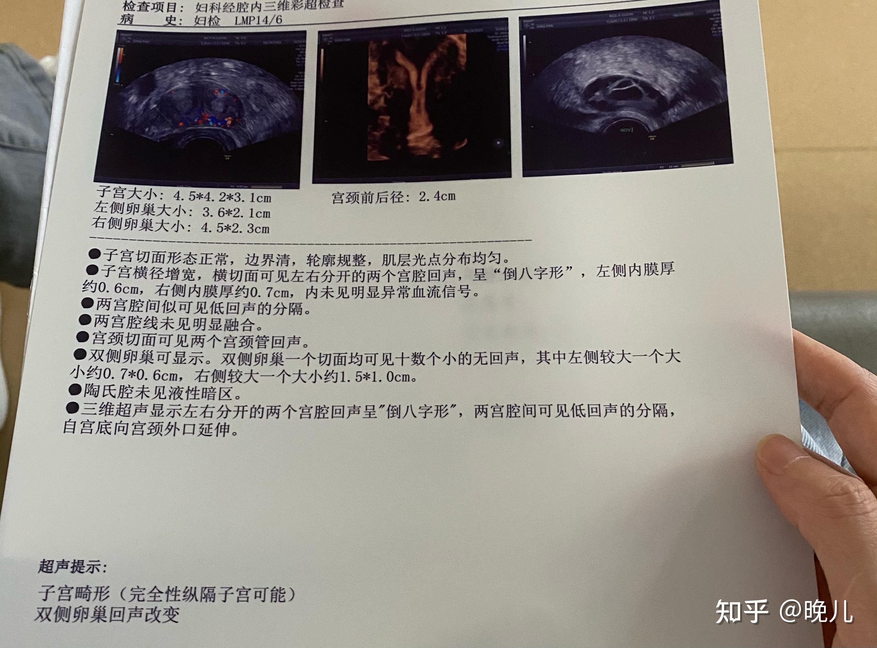 不完全纵隔子宫怀孕图片