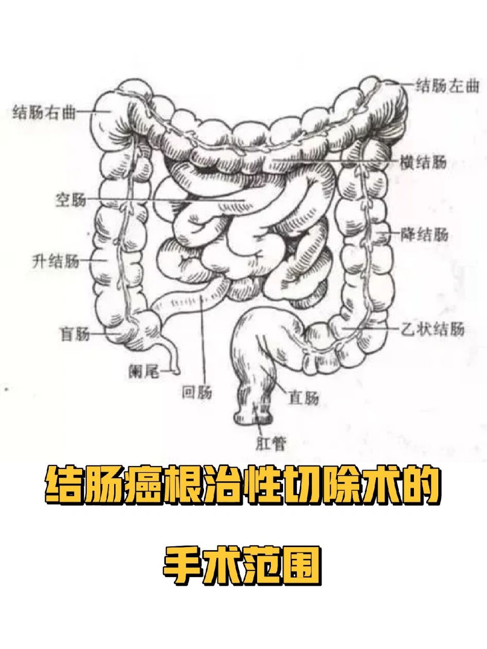 结肠癌根治性切除术的手术范围 根治性切除术是结肠