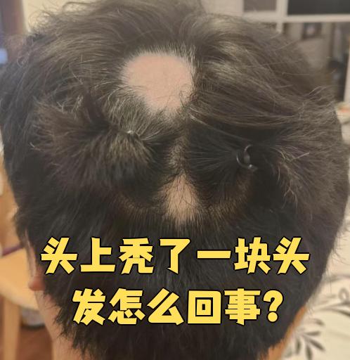 为什么头发会突然秃了一块可以用酒精吗为什么在线