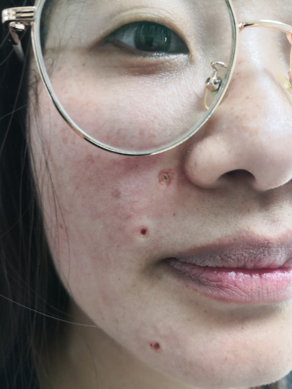 面部色素痣激光治疗去除后即刻图片.