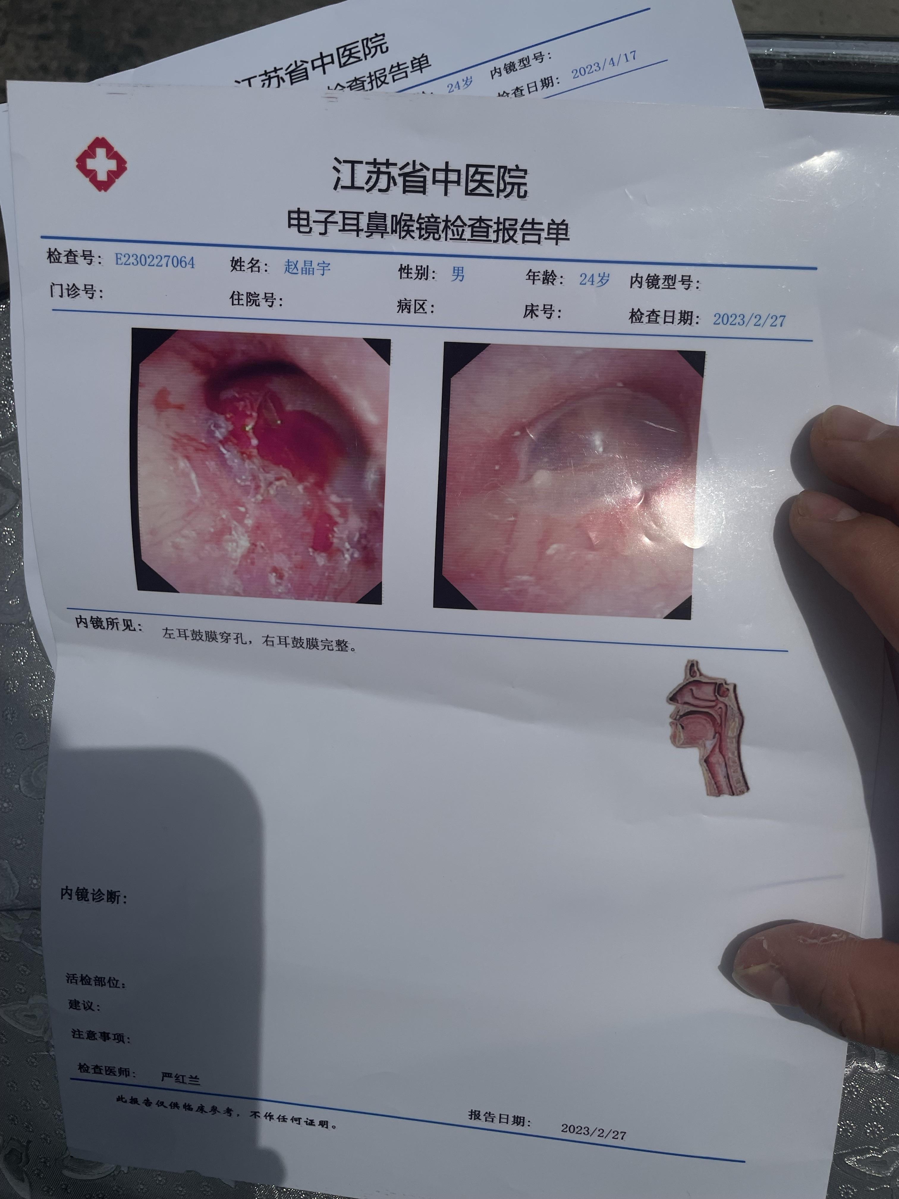 知乎用户n 的想法  鼓膜穿孔鉴定