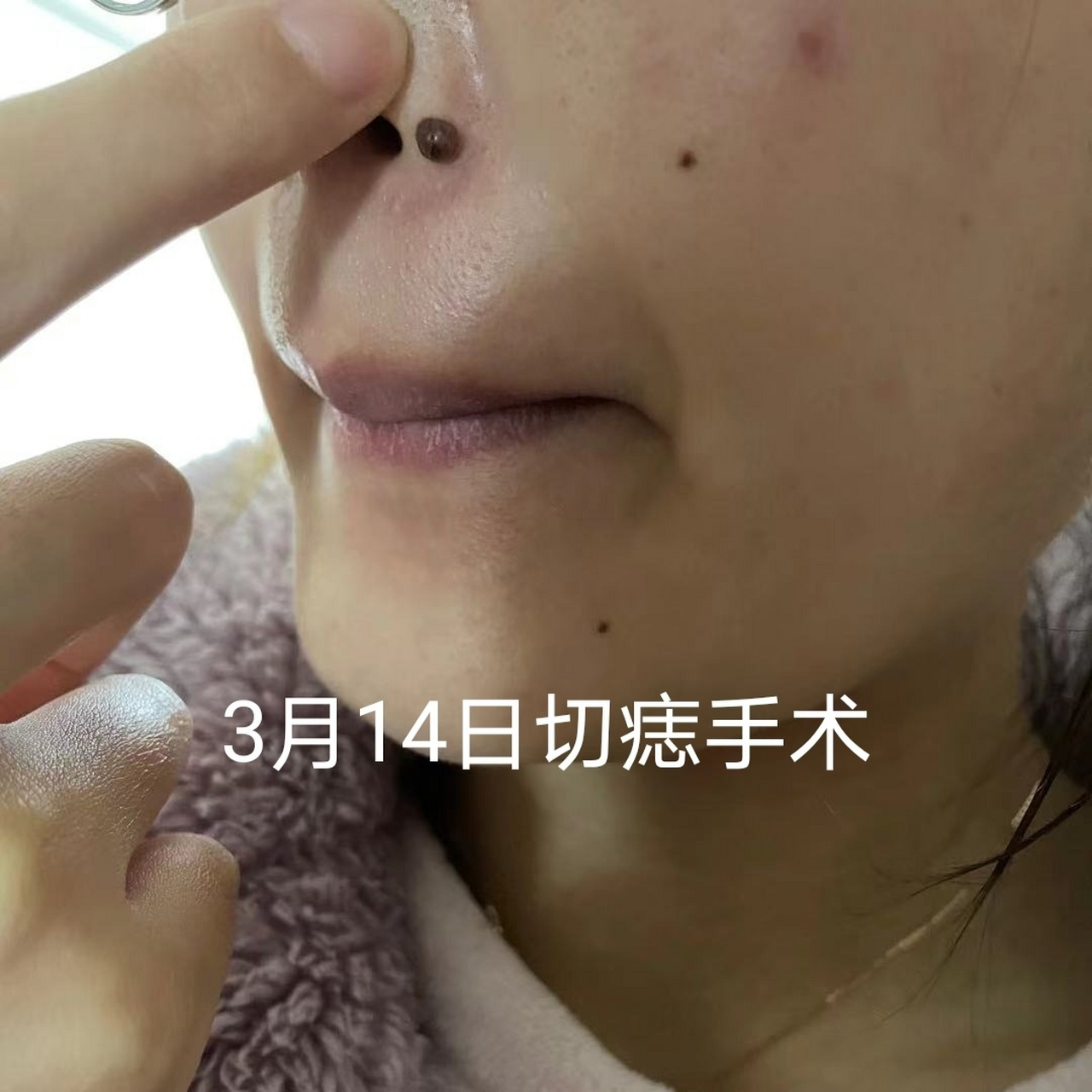 一个切痣恢复效果图 手术切除色素痣,护理好了一般不会留疤,一个月的