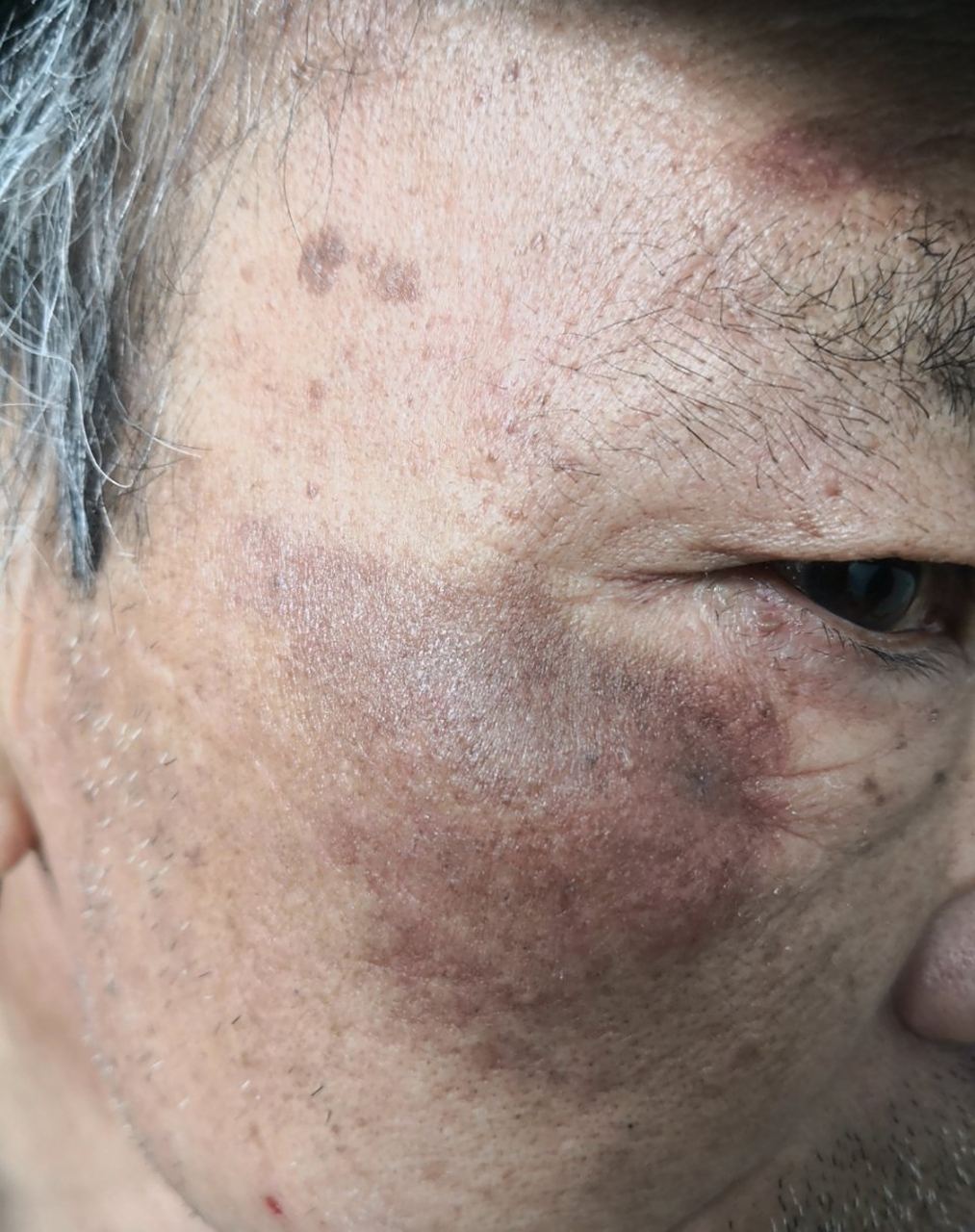 色素沉着##老年斑