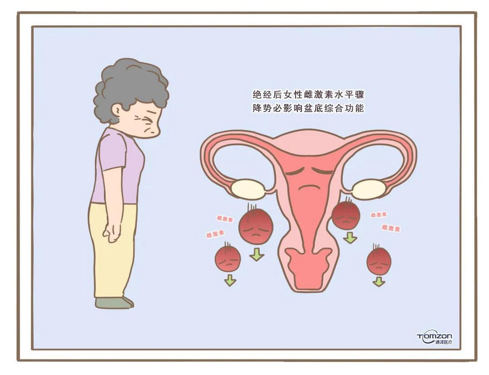 绝经综合征是指女性进入更年期后,由于卵巢功能逐渐减退,导致身体出现