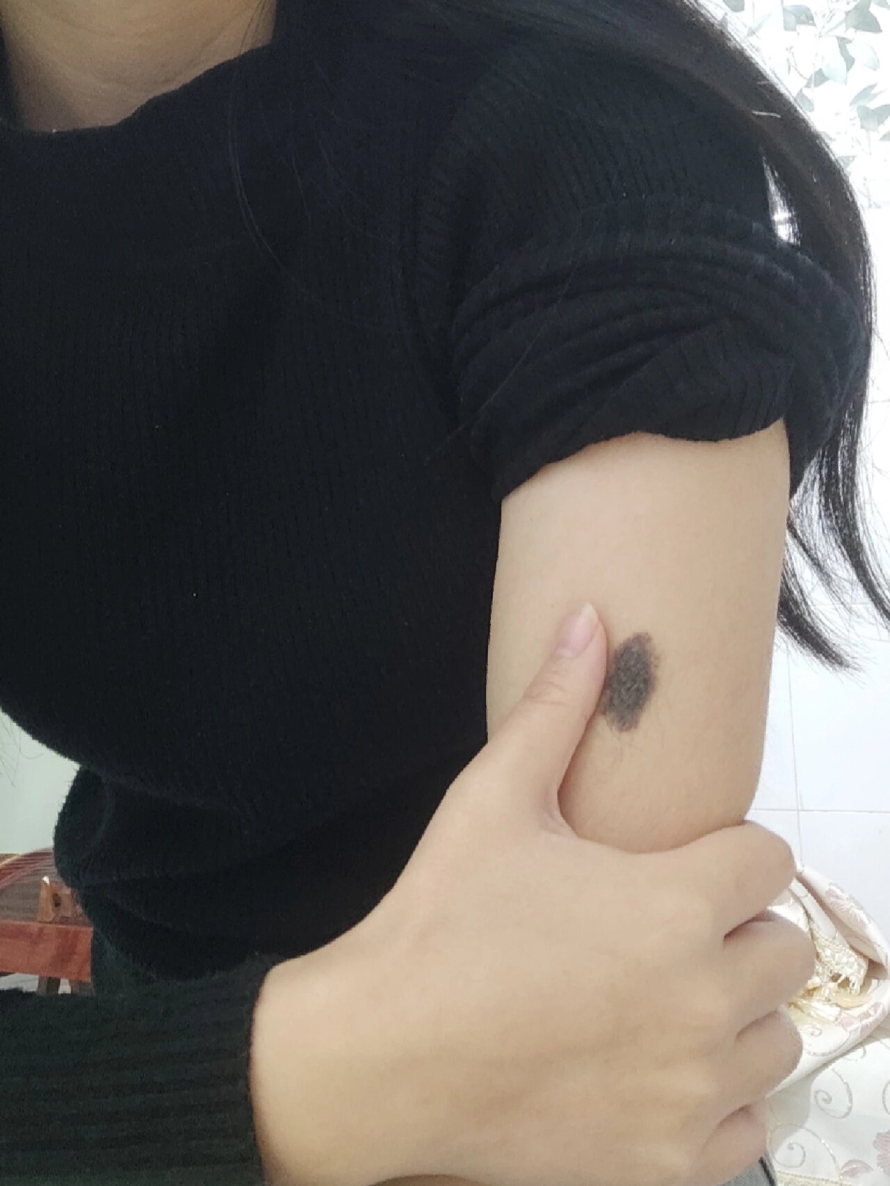 我这个是黑色素痣吗?