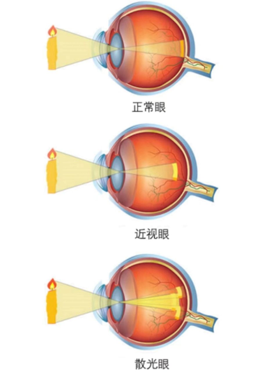 散光可以矫正过来吗图片