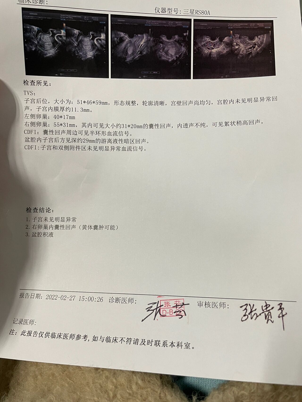 黄体囊肿是什么意思
