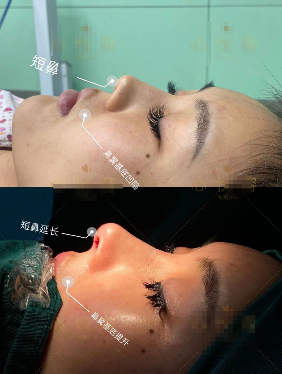短鼻延长,尤其术前有鼻小柱上缩,上唇人中长的.