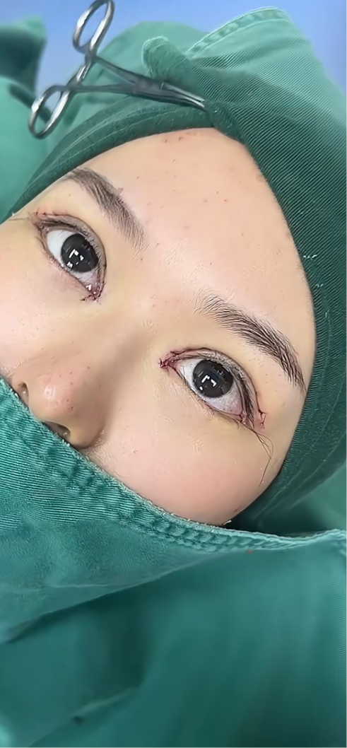 双眼皮拆线时间可以适当推迟几天.一般来说,拆线时间在术后7