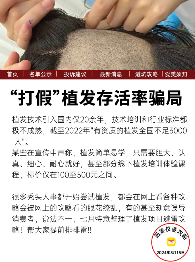 植发能不能二次植发呢(植发能不能二次植发呢图片)