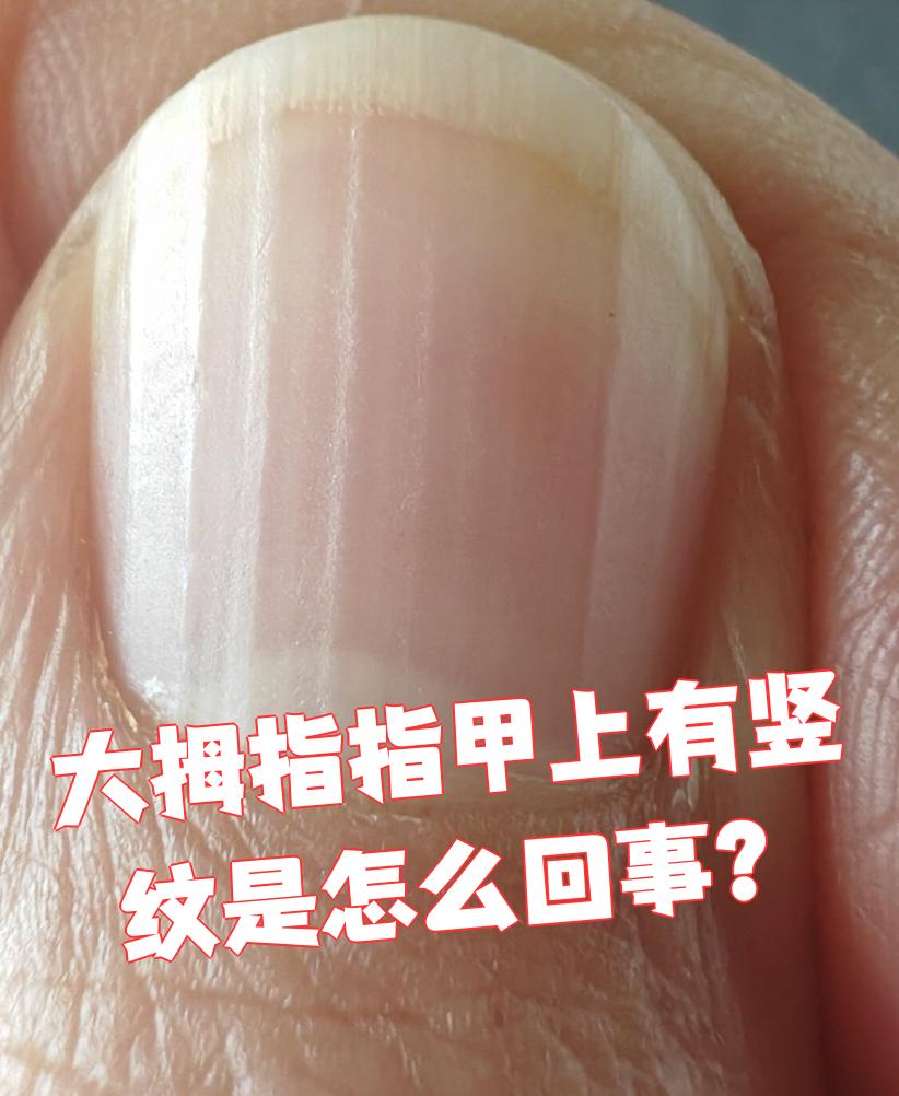 大拇指指甲出现竖纹很常见,可能有以下几种原因: