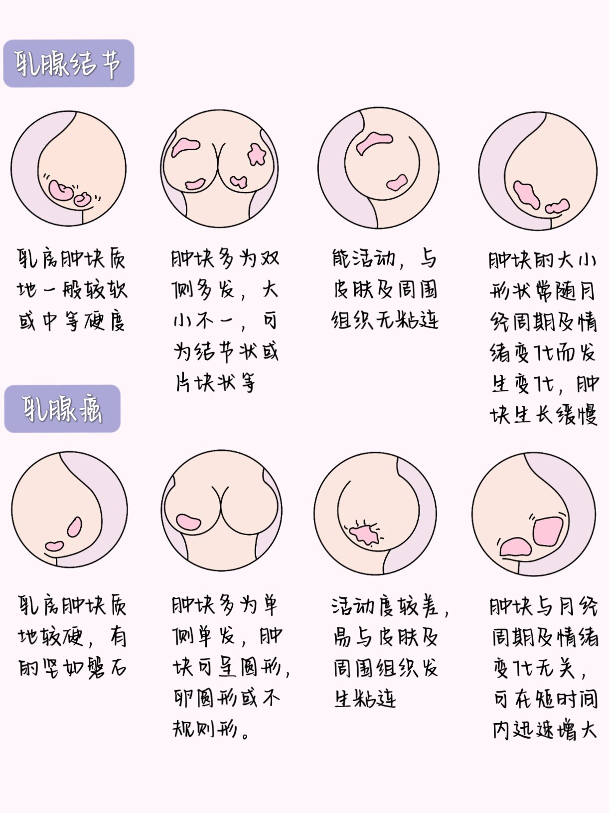 医学生笔记7199(妇科篇)/乳头内陷