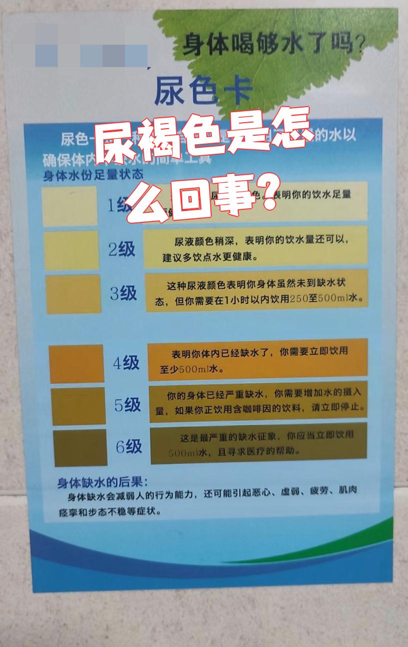 尿液变成褐色主要有两个原因:要么是尿路里有陈旧出血,要么是胆贺素