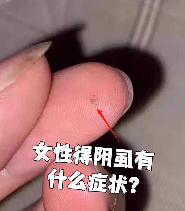 女性得阴虱后最常见的症状是瘙痒,尤其是生殖器部位会特别痒