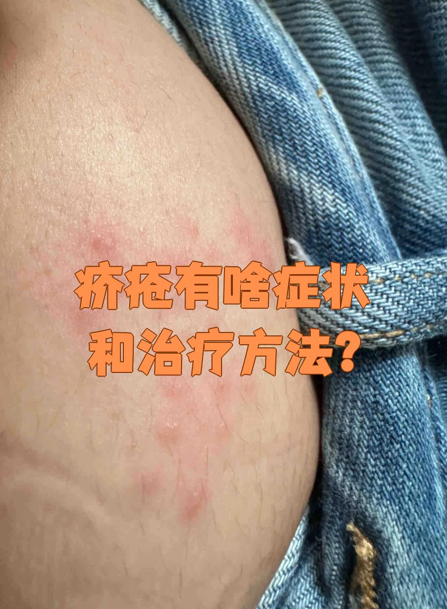 疥疮有啥症状和治疗方法?