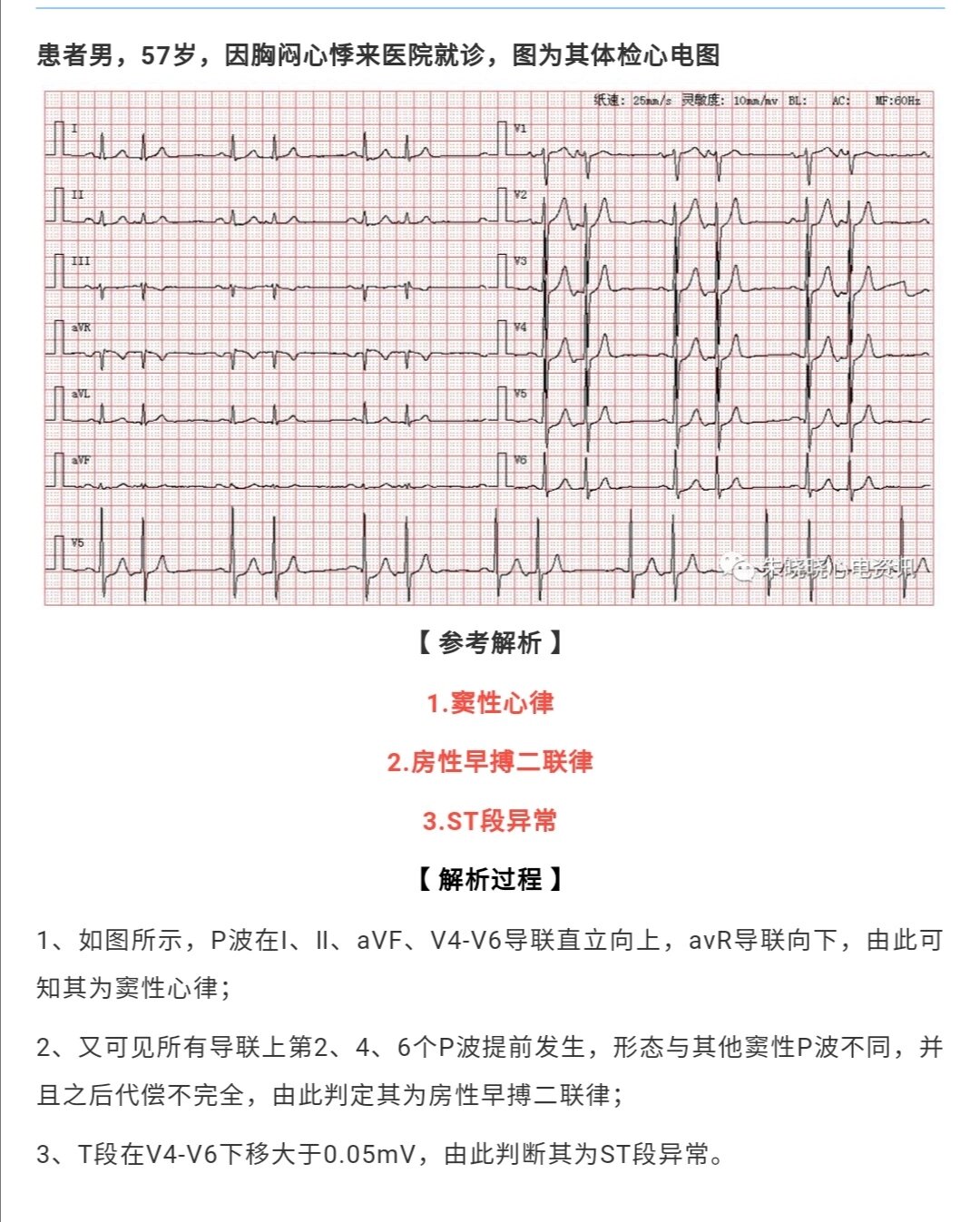 房性早搏二联律