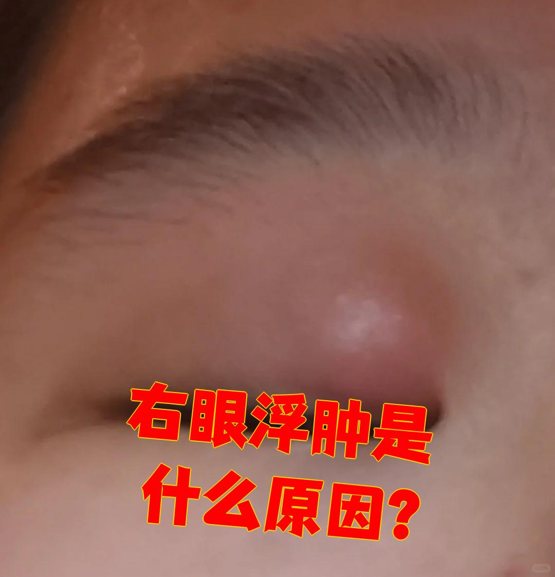 右眼浮肿最常见的原因是霰粒肿和结膜炎