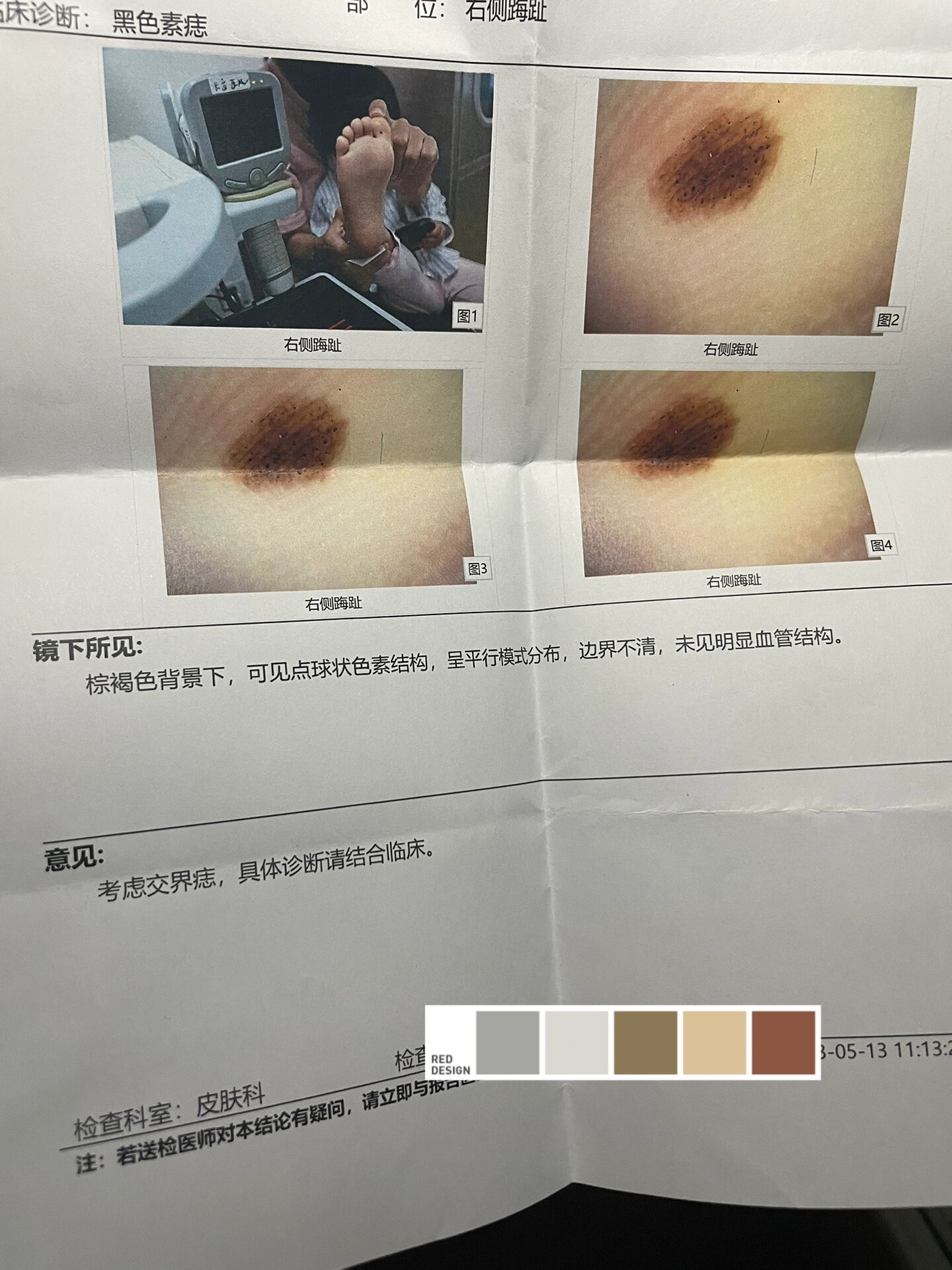 交界痣 两岁半的宝宝.有谁懂啊.这种痣是不是要嘎掉.手术要麻醉吗?