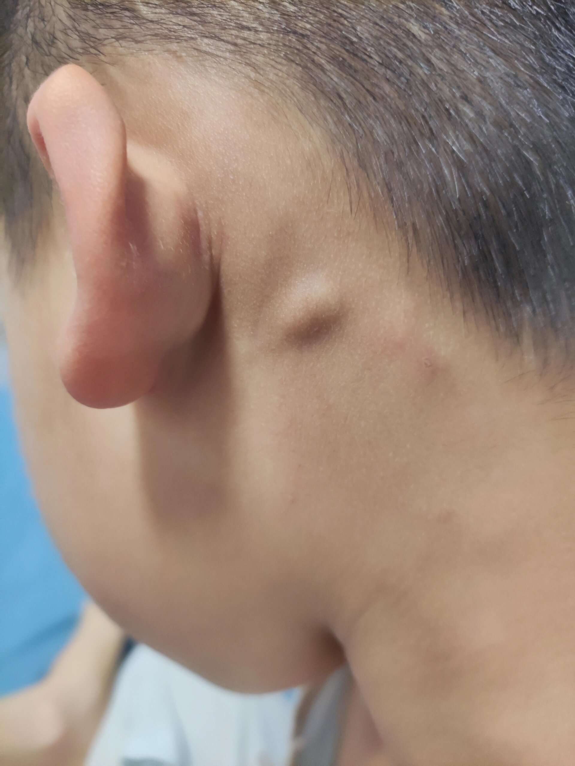 儿童耳后淋巴