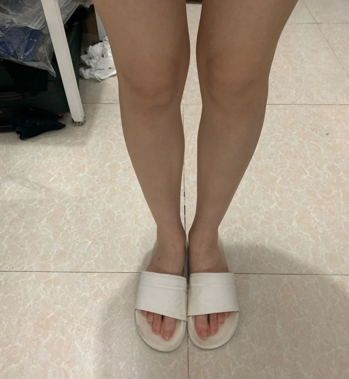 就说这腿歪的该如何拯救 这算小腿外翻吧,但是是从膝盖那里就开始歪了